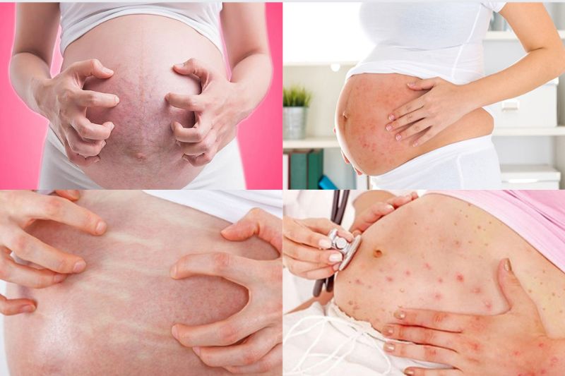Giải đáp mẹ bầu bị ngứa da khi mang thai có nguy hiểm không?