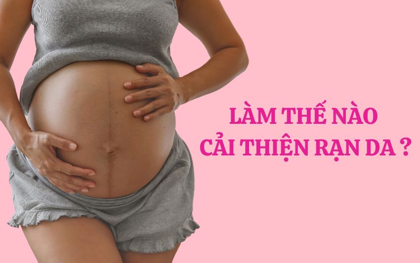 3 cách cải thiện rạn da mới hình thành và lâu năm cho mẹ bầu