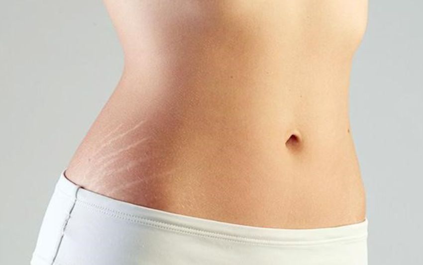 Kem chống rạn da cho bà bầu loại nào tốt 2023 - Abera mẹ và bé