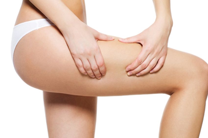 Rạn da là gì? Nguyên nhân và cách phòng ngừa