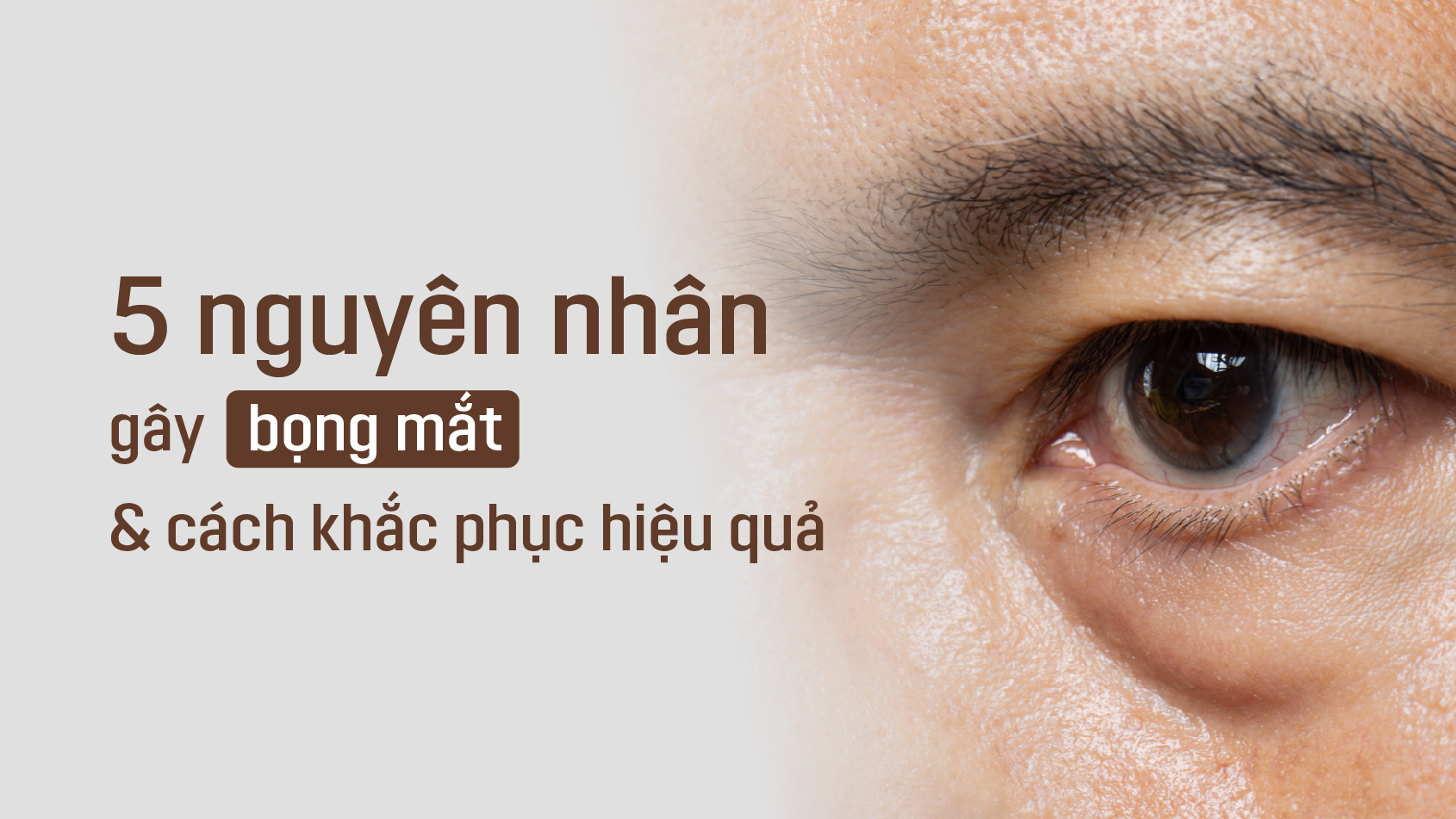 5 nguyên nhân chính gây bọng mắt và cách khắc phục hiệu quả